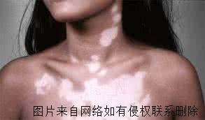 女性白癜风怎么科学医治