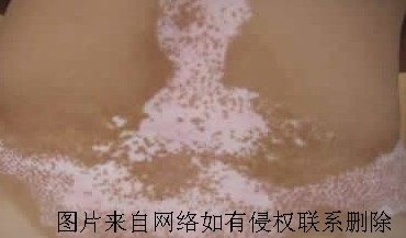 手心白癜风要怎么见效的治疗