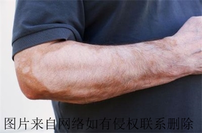 男性白癜风要怎么进行医治