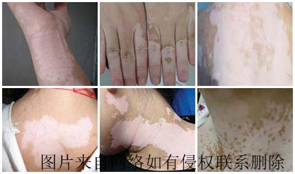散发型白癜风有什么诊断依据