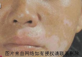 广州看白癜风多少钱