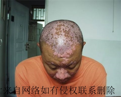 男性白癜风难治愈是什么原因