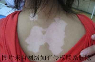 女性皮肤上出现白斑常见的危害